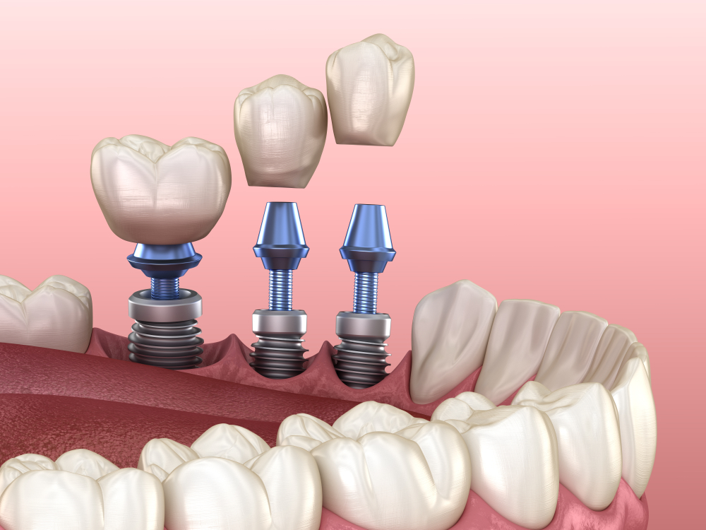 Dental implants Kent